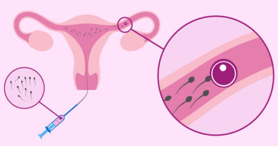 Infertility